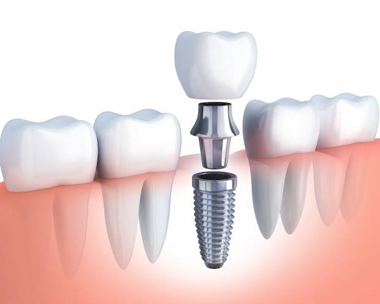 a photo about Common Problems After Dental Implant Surgery that Deserve Prompt Attention