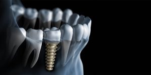 Different types of dental implants