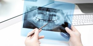 Risks of Not Removing Wisdom Teeth