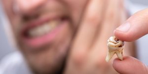Preventing Tooth Decay