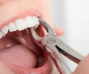 Emergency Tooth Extractions