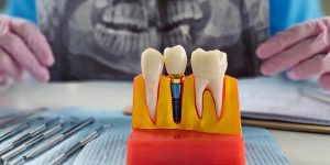What Is Bone Grafting and Why Is It Needed?