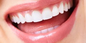 dental-veneers