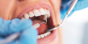 Dental Fillings