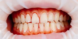 a photo of a patient's bleeding gums