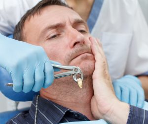 Tooth Extraction in North York Tooth Extraction in North York